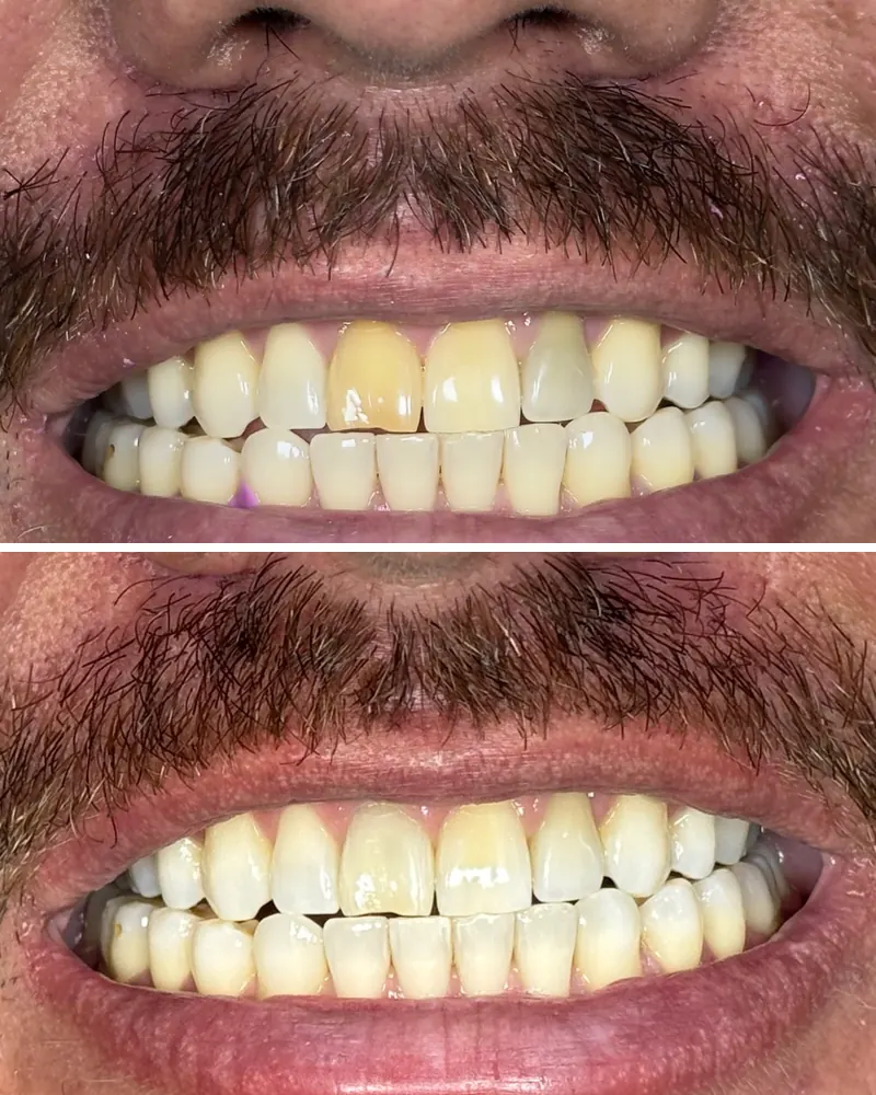 Dente da frente escurecido antes e depois do tratamento