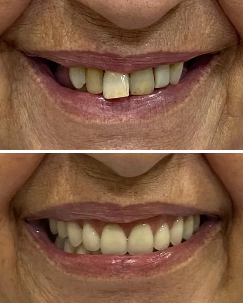 Sorriso de paciente antes e depois da reabilitação com prótese