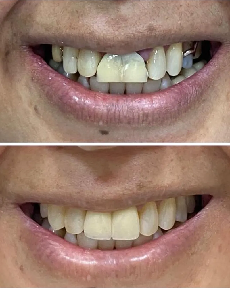 Sorriso antes e depois da prótese dentária