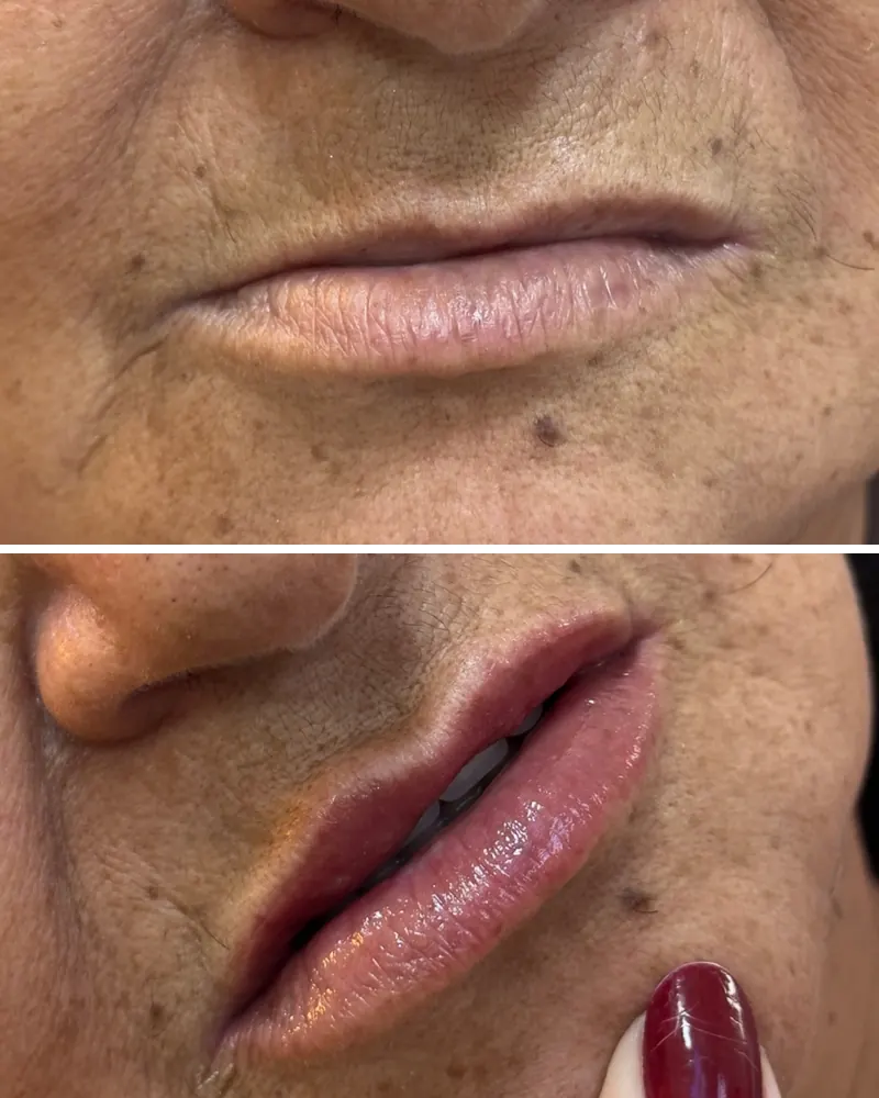 Lábios antes e depois do preenchimento labial