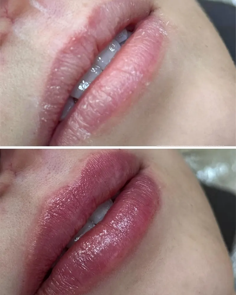 Lábios antes e depois do preenchimento labial