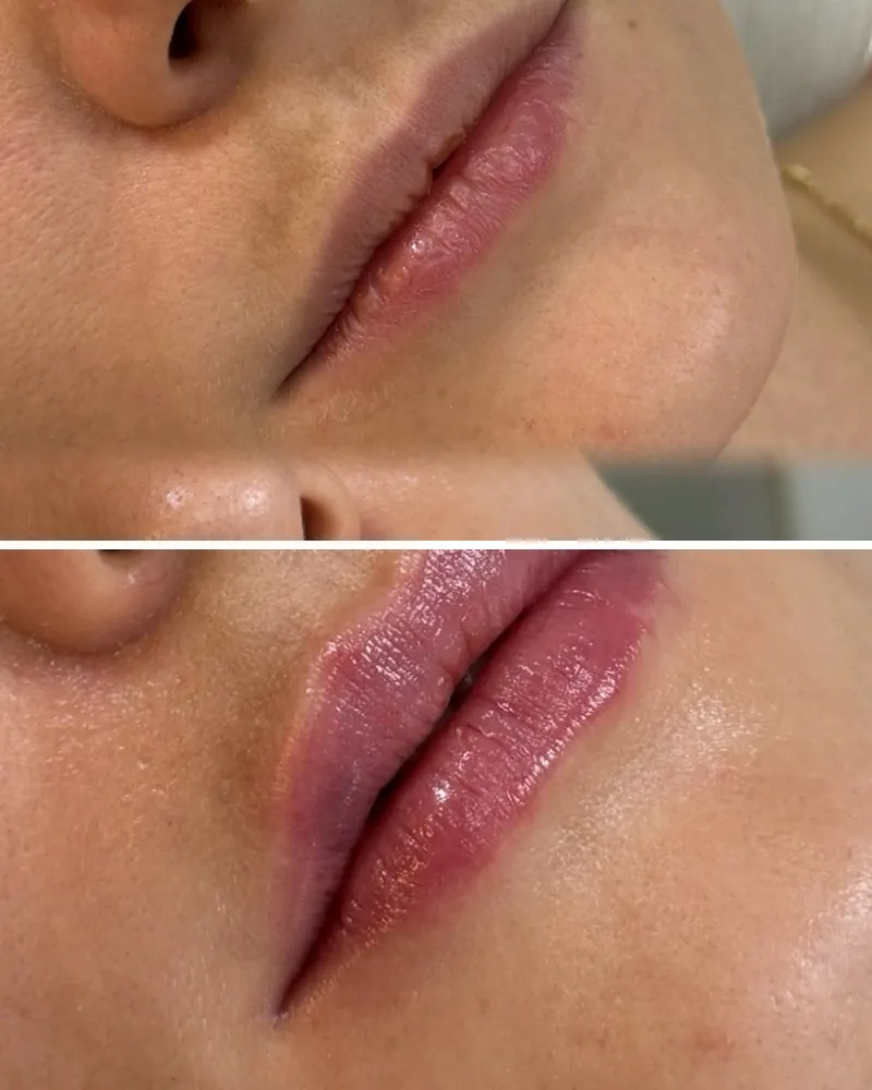 Lábios antes e depois do preenchimento labial