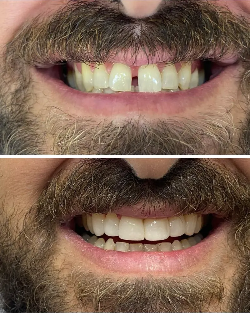 Sorriso antes e depois de lentes de contato dental, com diastema fechado