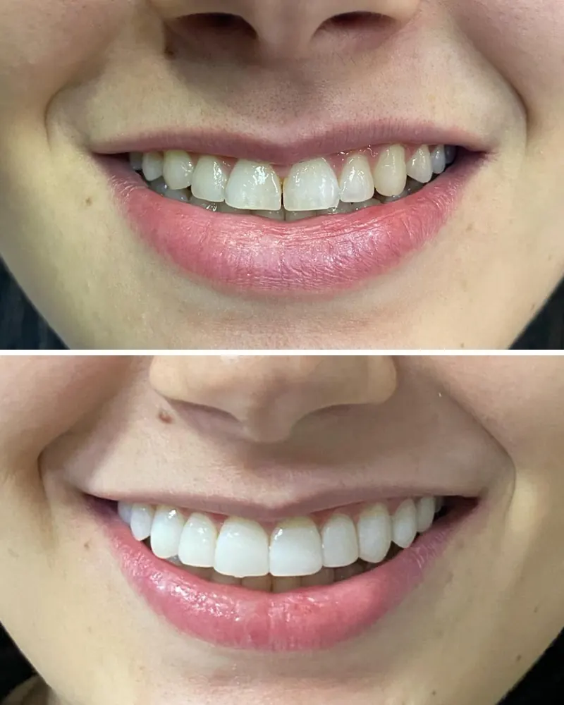 Sorriso antes e depois de lentes de contato dental