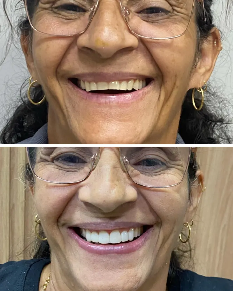 Sorriso de paciente de óculos antes e depois do tratamento estético