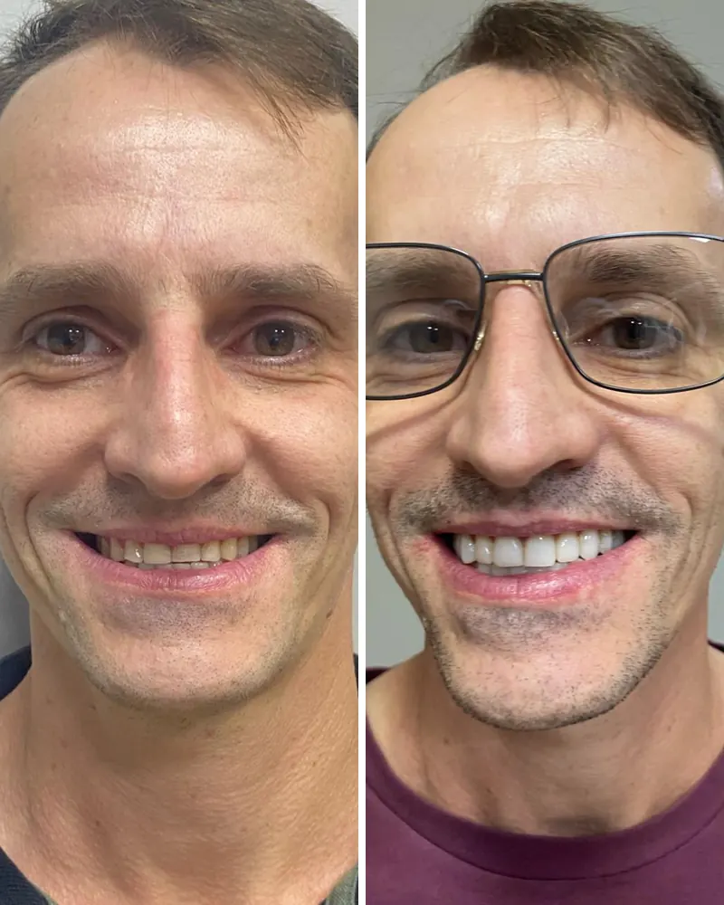 Rosto de paciente antes e depois de lentes de contato dental