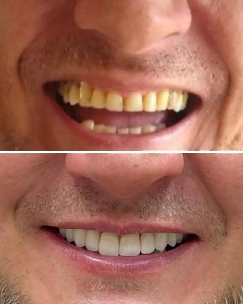 Dentes desgastados antes e depois de lentes de contato dental