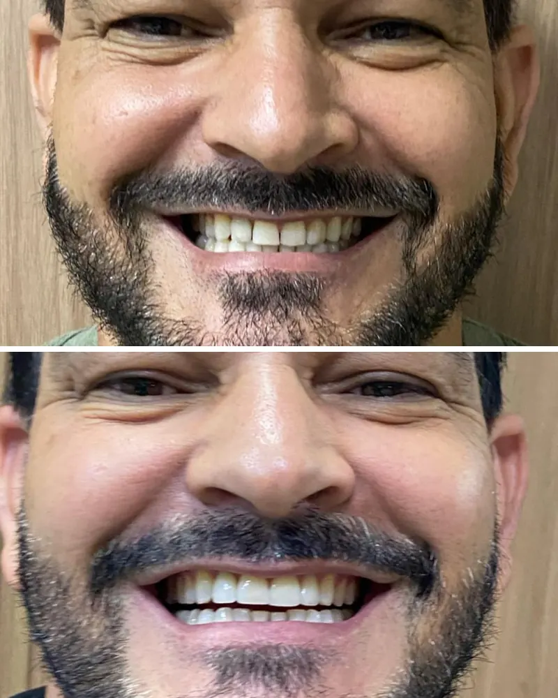 Sorriso antes e depois de lentes de contato dental