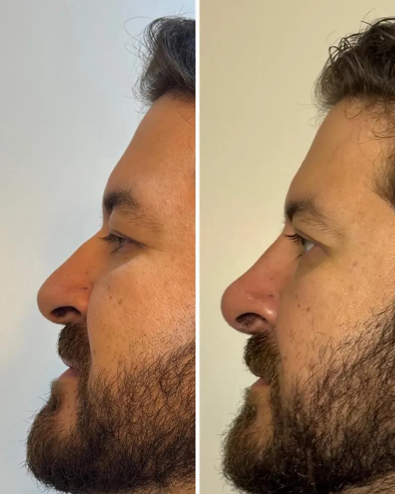 Perfil masculino antes e depois da rinomodelação