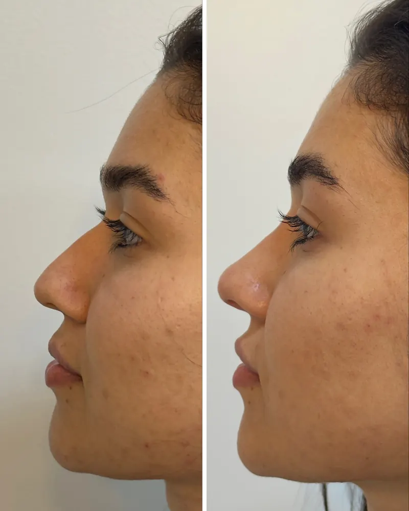 Perfil feminino antes e depois da rinomodelação