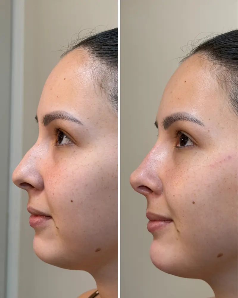 Perfil feminino antes e depois da rinomodelação