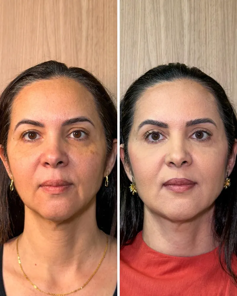 Rosto de frente antes e depois do rejuvenescimento facial