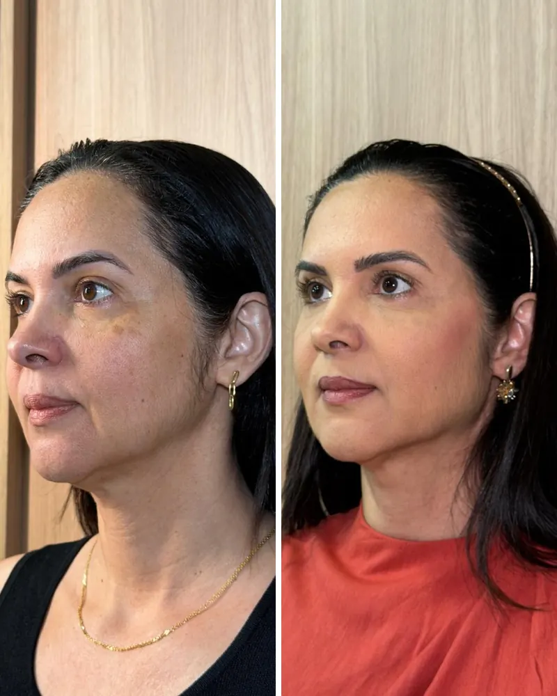 Rosto de perfil antes e depois do rejuvenescimento facial